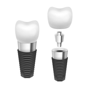 Fog implantátumok